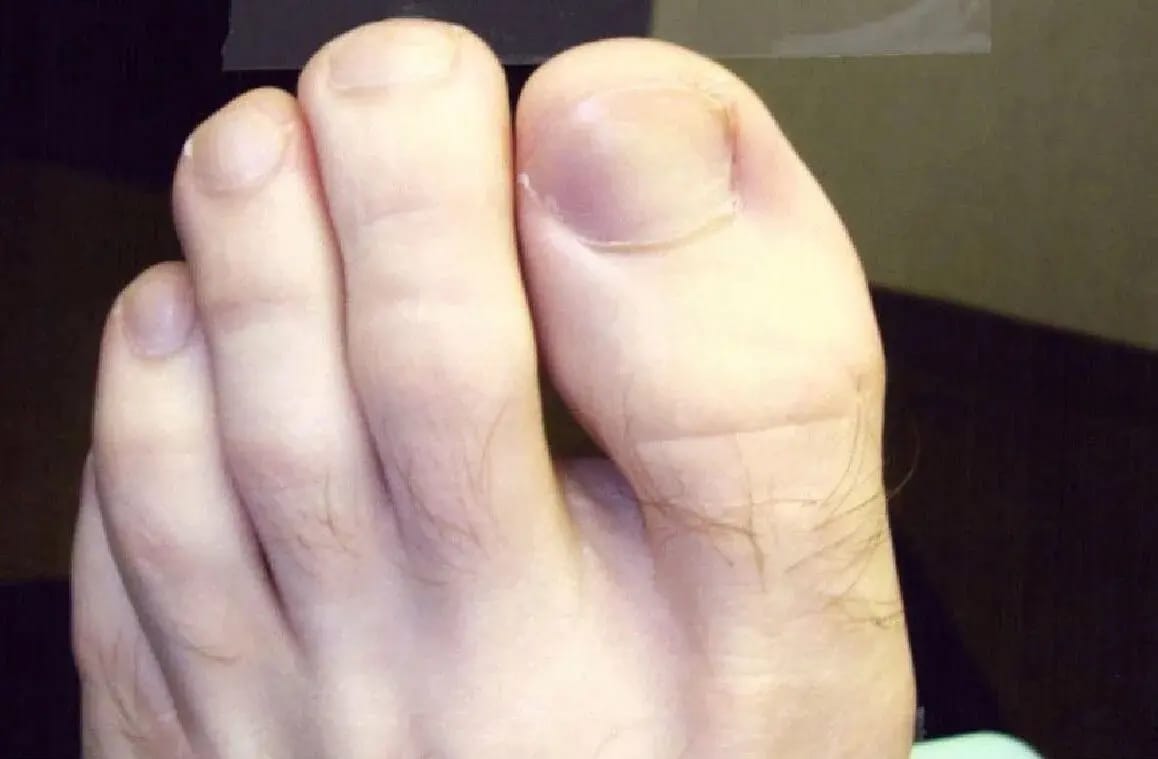 Customer photo review of VELCURA™ Fungal Nail Patches