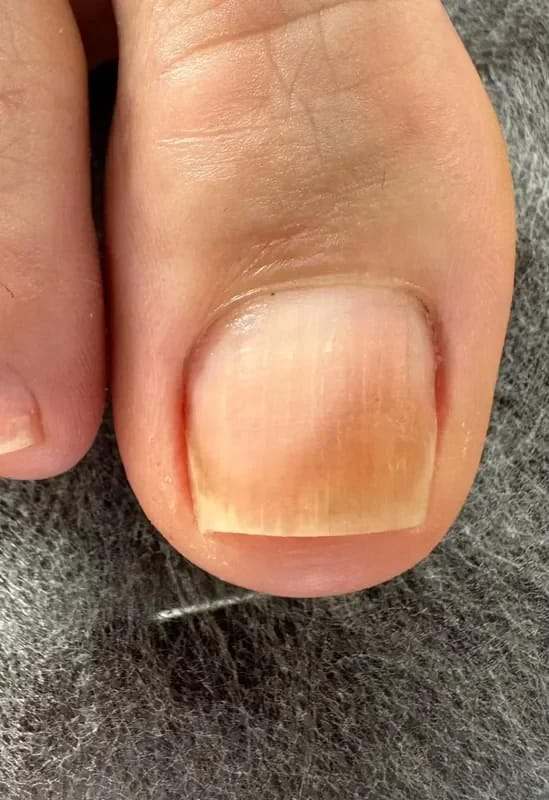 Customer photo review of VELCURA™ Fungal Nail Patches