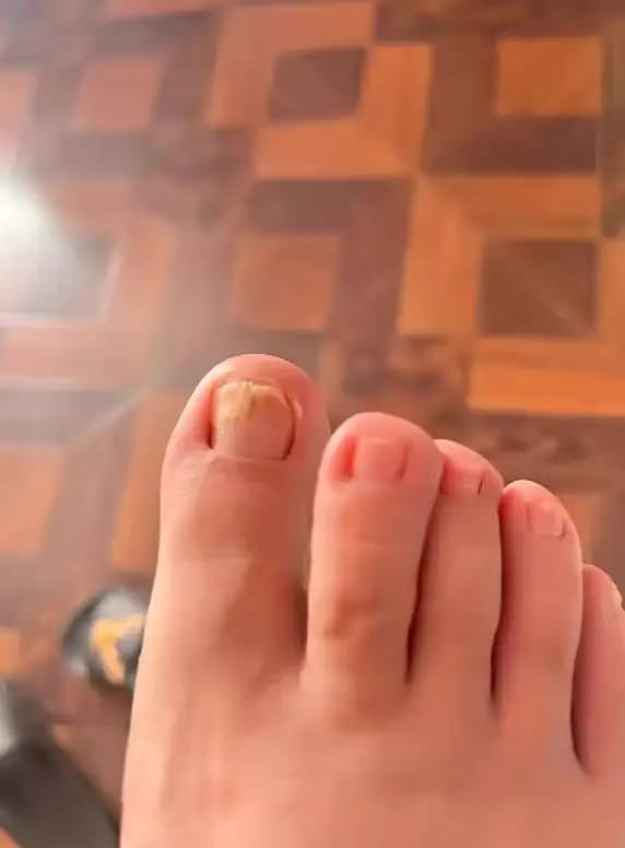 Customer photo review of VELCURA™ Fungal Nail Patches