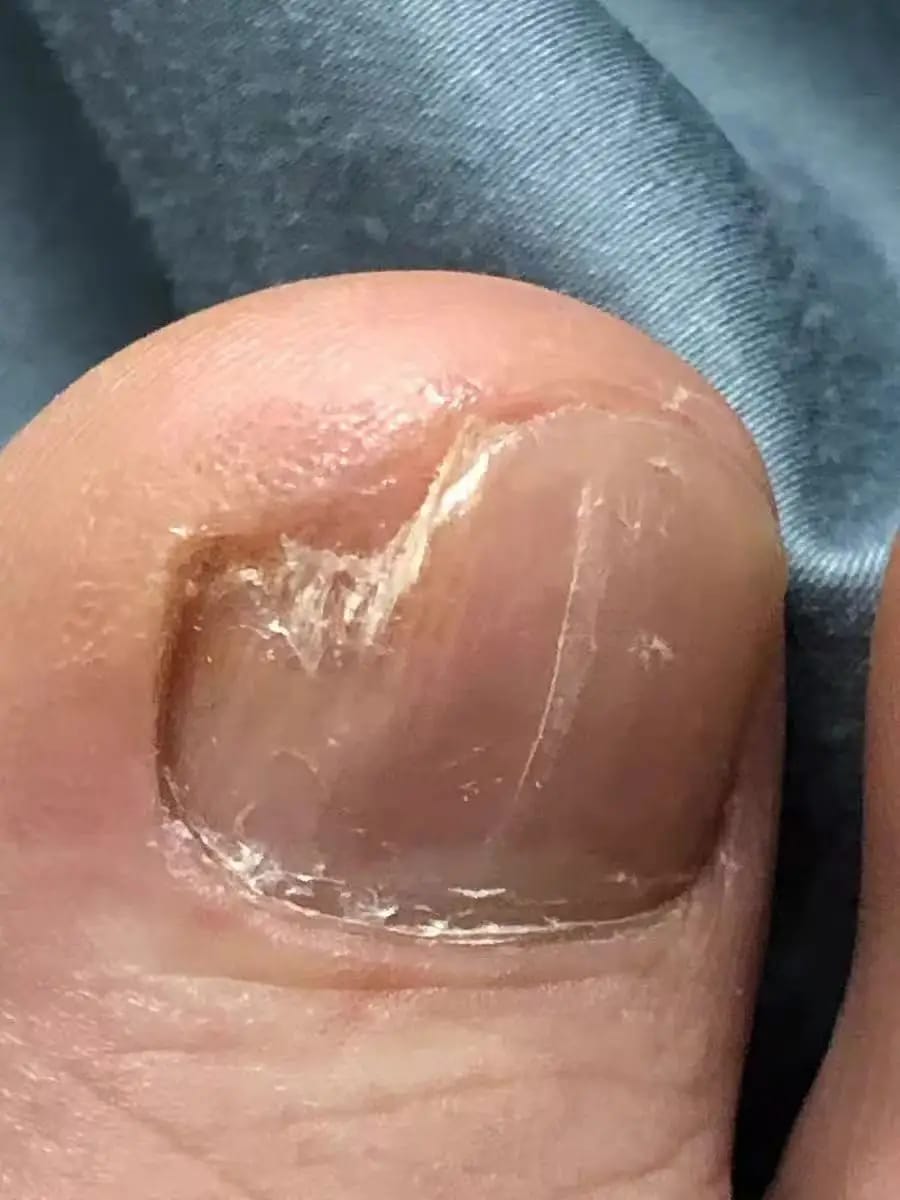 Customer photo review of VELCURA™ Fungal Nail Patches