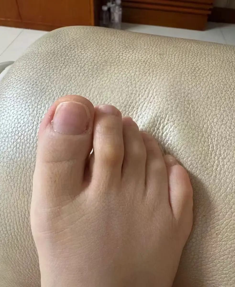 Customer photo review of VELCURA™ Fungal Nail Patches