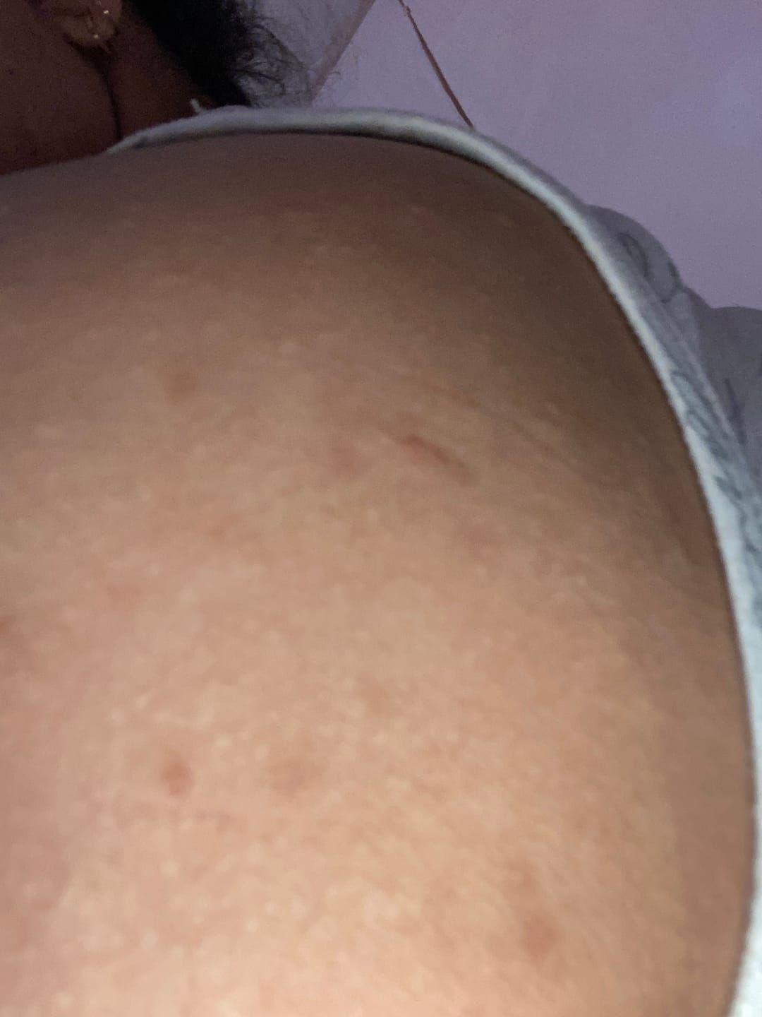Customer photo review of Kit Acné
