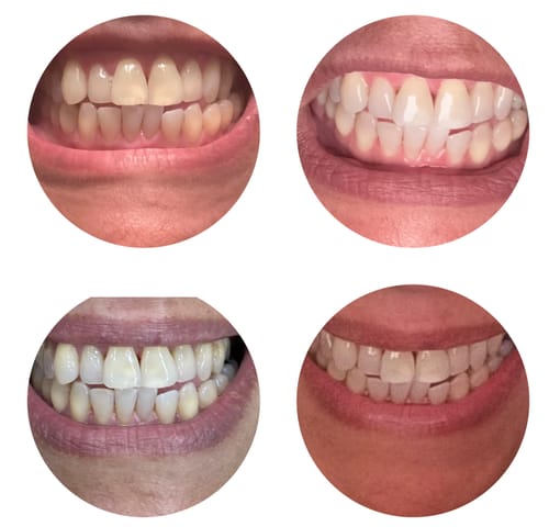 Customer photo review of Polar MD Teeth Whitening Kit