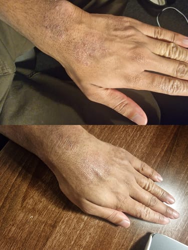 Customer photo review of Eczema Scratch Mitten
