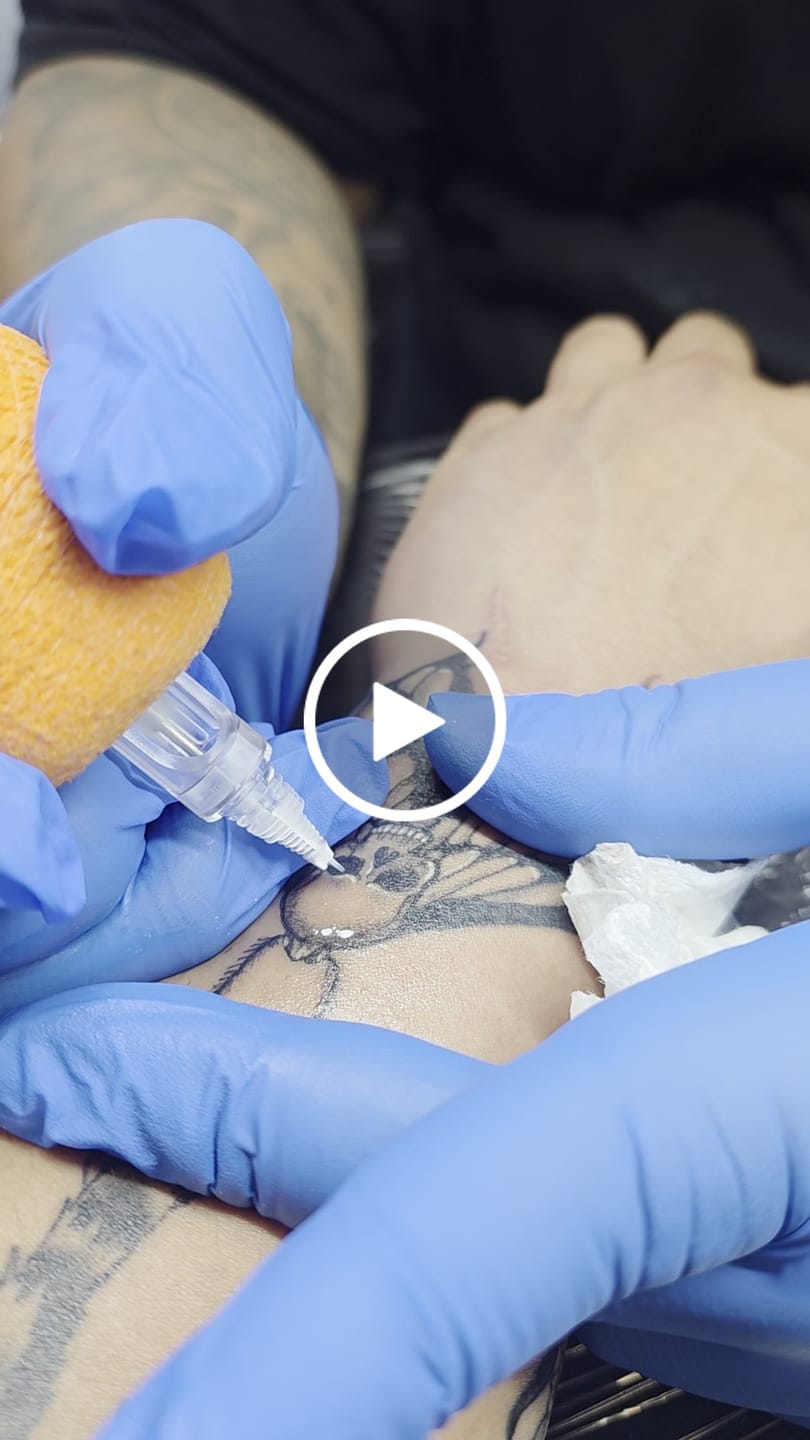 Customer video review of T&T AWE Tattoo Needles Round Liner (20 pcs/box)