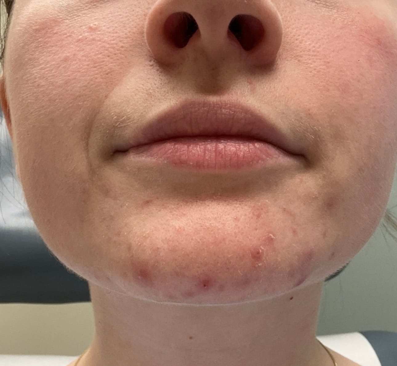 Customer photo review of Kill Acne & Redness Ritual