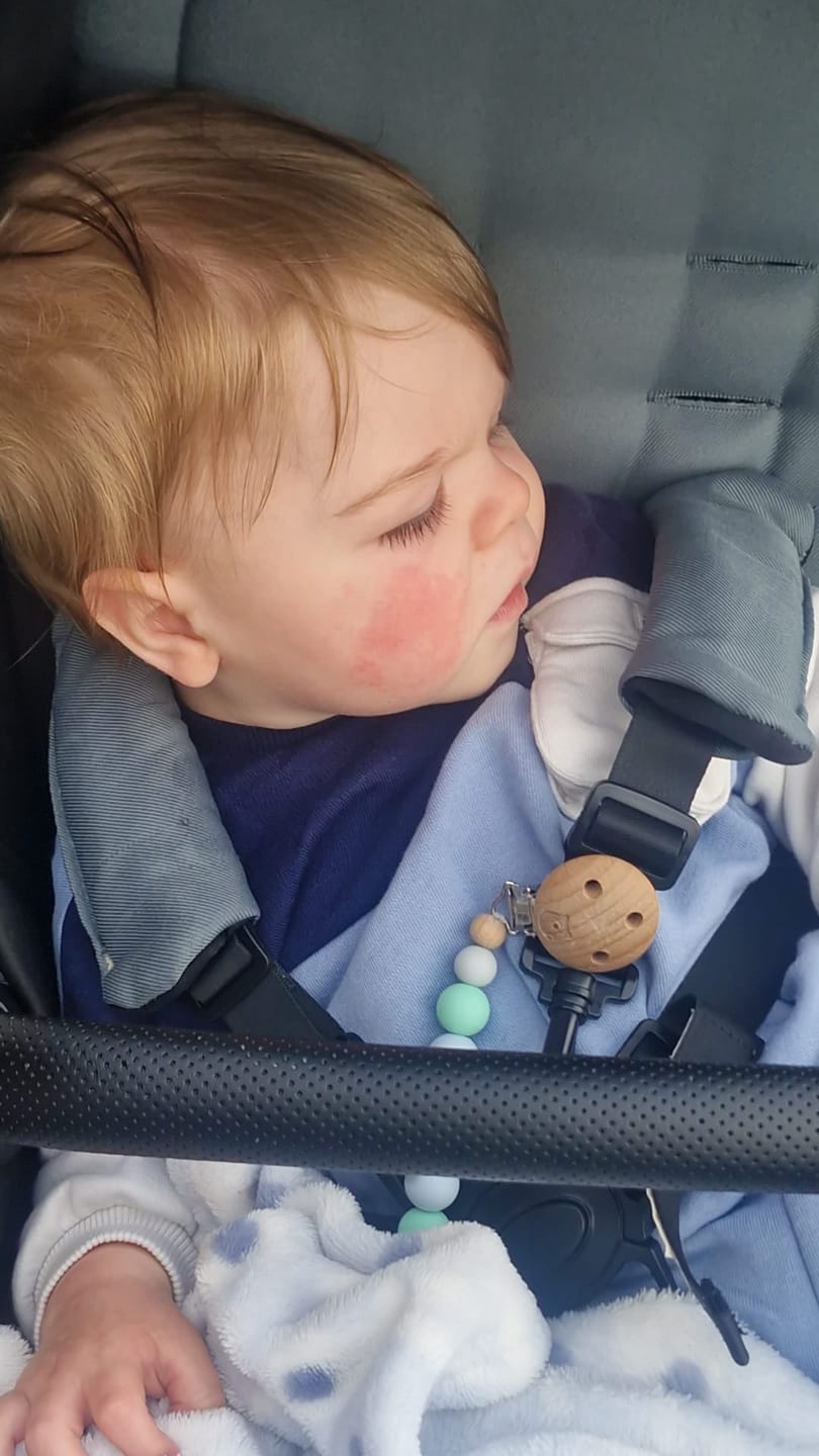 Customer photo review of Bioskin Junior Outbreak Rescue Cream