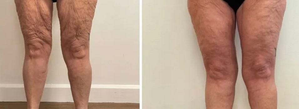 Customer photo review of Solasculp™ ContourBand – Arm & Thigh Red Light Therapy