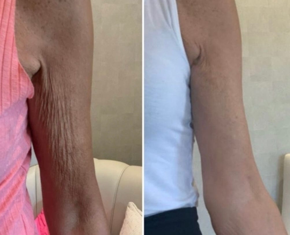 Customer photo review of Solasculp™ ContourBand – Arm & Thigh Red Light Therapy