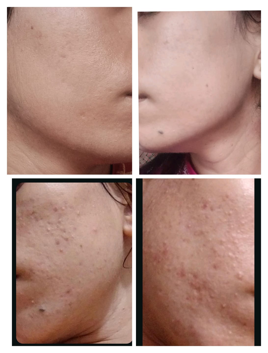 Customer photo review of NiaRonic Serum (Pore Minimizing)