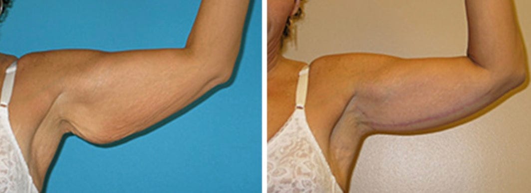 Customer photo review of Solasculp™ ContourBand – Arm & Thigh Red Light Therapy