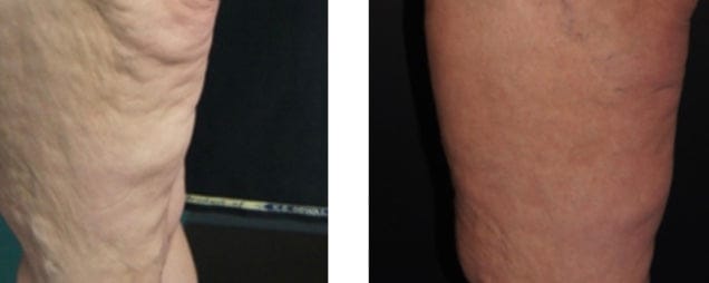 Customer photo review of Solasculp™ ContourBand – Arm & Thigh Red Light Therapy