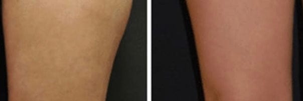 Customer photo review of Solasculp™ ContourBand – Arm & Thigh Red Light Therapy