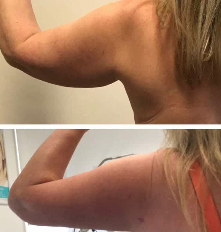 Customer photo review of Solasculp™ ContourBand – Arm & Thigh Red Light Therapy