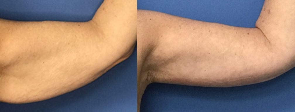 Customer photo review of Solasculp™ ContourBand – Arm & Thigh Red Light Therapy