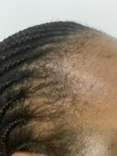 Customer photo review of Scalp Serum Set - Minoxidil