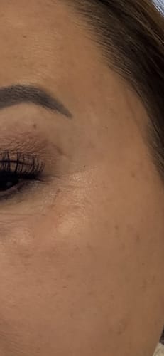 Customer photo review of 3 Month Supply - Seranova Micro Infusion System