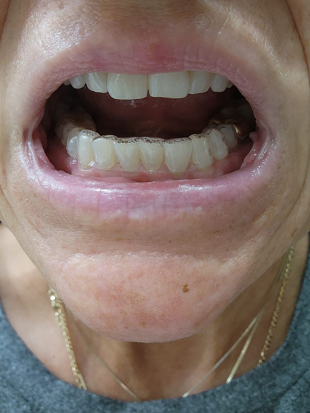 Customer photo review of Premium Lower Retainer