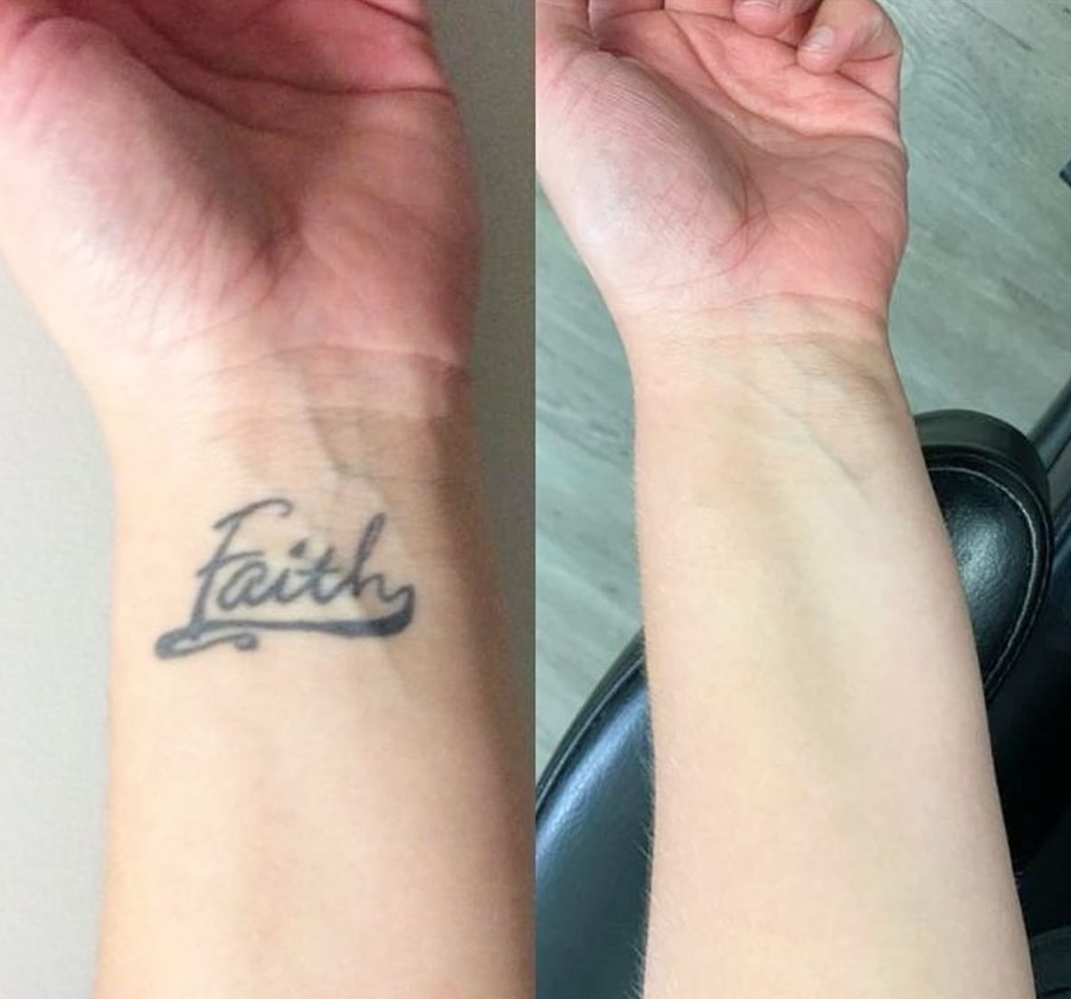 Customer photo review of Laser Tattoo Removal Machine Q-switched ND YAG