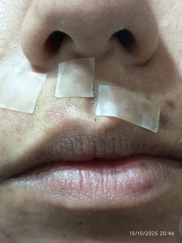 Customer photo review of Hydrocolloid Treatment