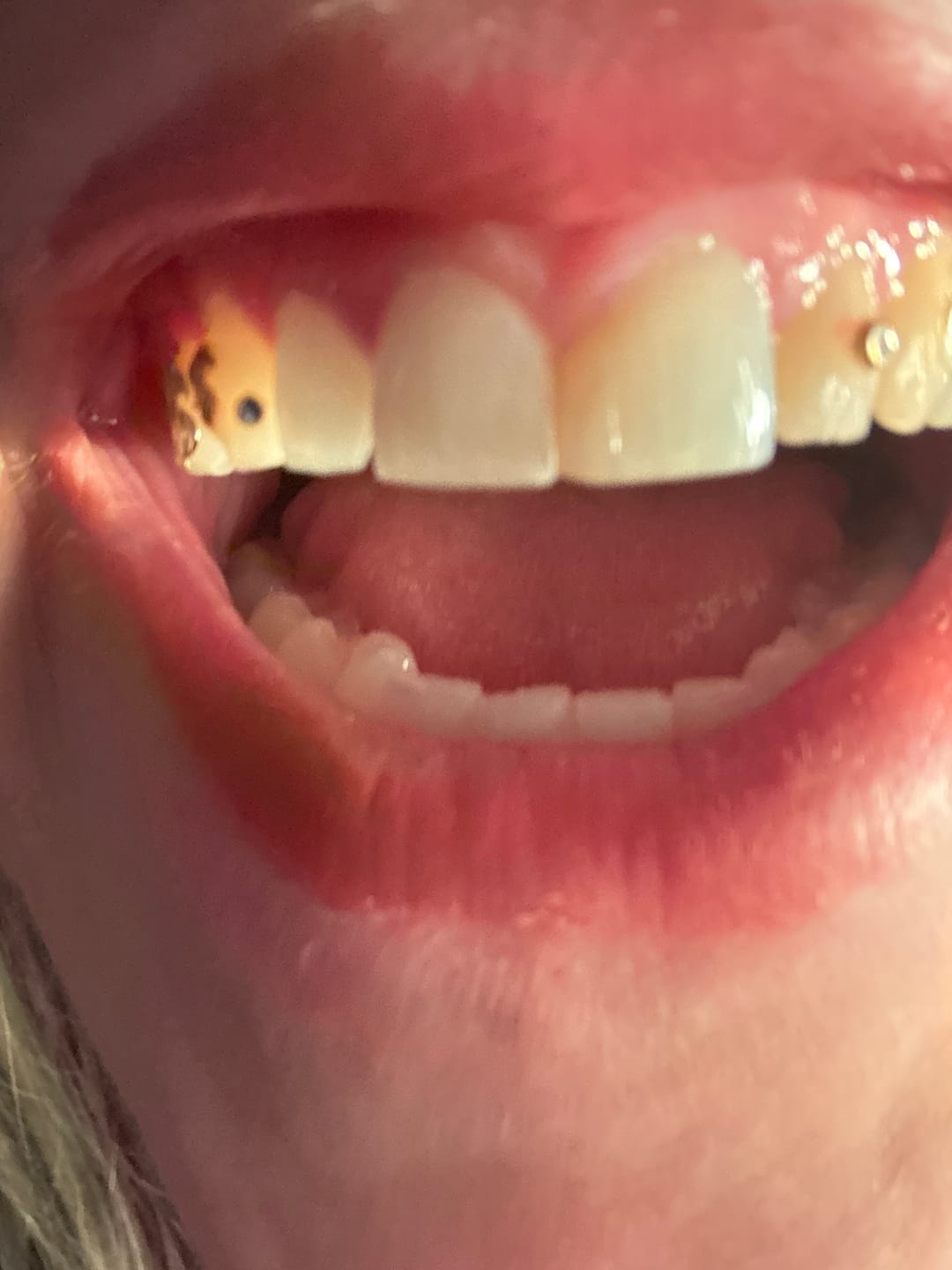 Customer photo review of Novelix™ Pro Whitening Strips