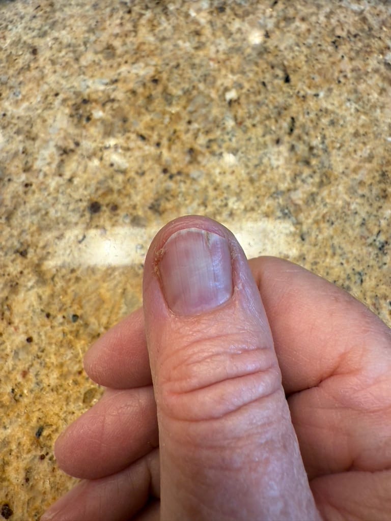 Customer photo review of Nail Strengthener and Growth Serum - Nail Care Pro