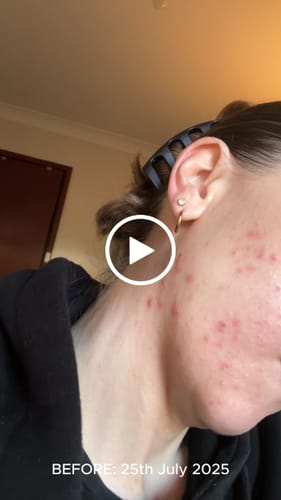 Customer video review of Intermediate Acne Program™