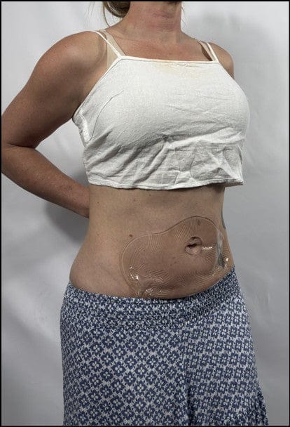 Customer photo review of Silicone Belly Patch