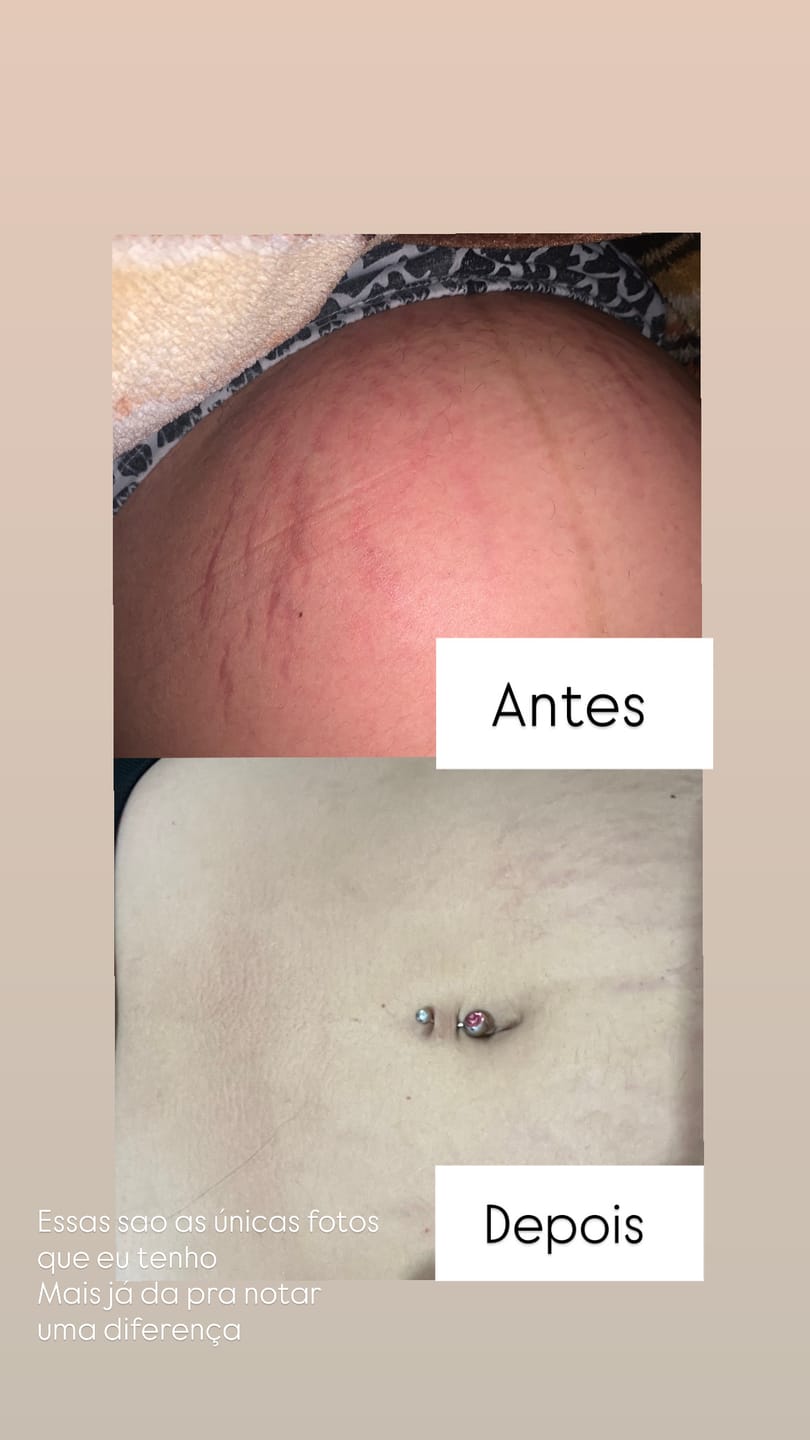 Customer photo review of Compre 2 Ganhe 1 - Creme Para Estrias