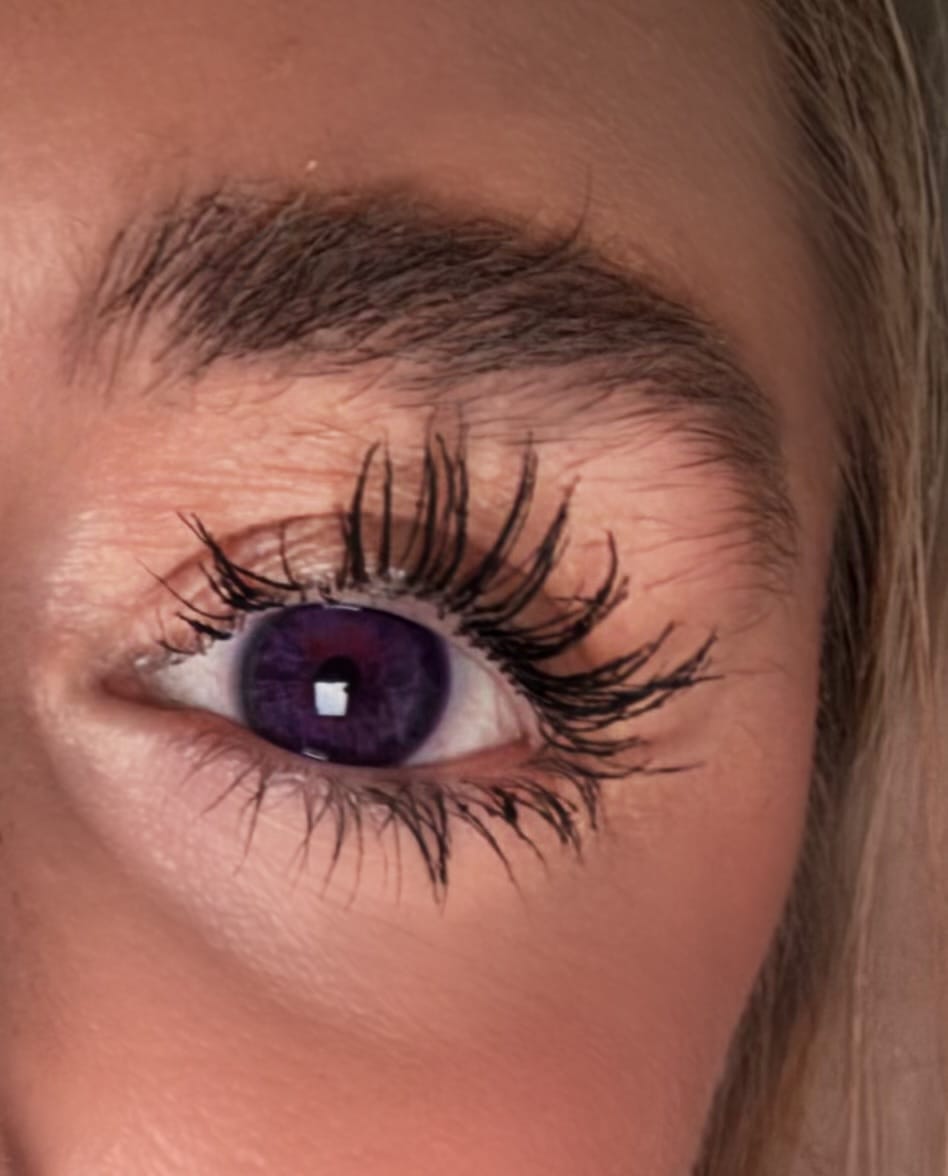 Customer photo review of Eyeling Custom Lens – 1 Month