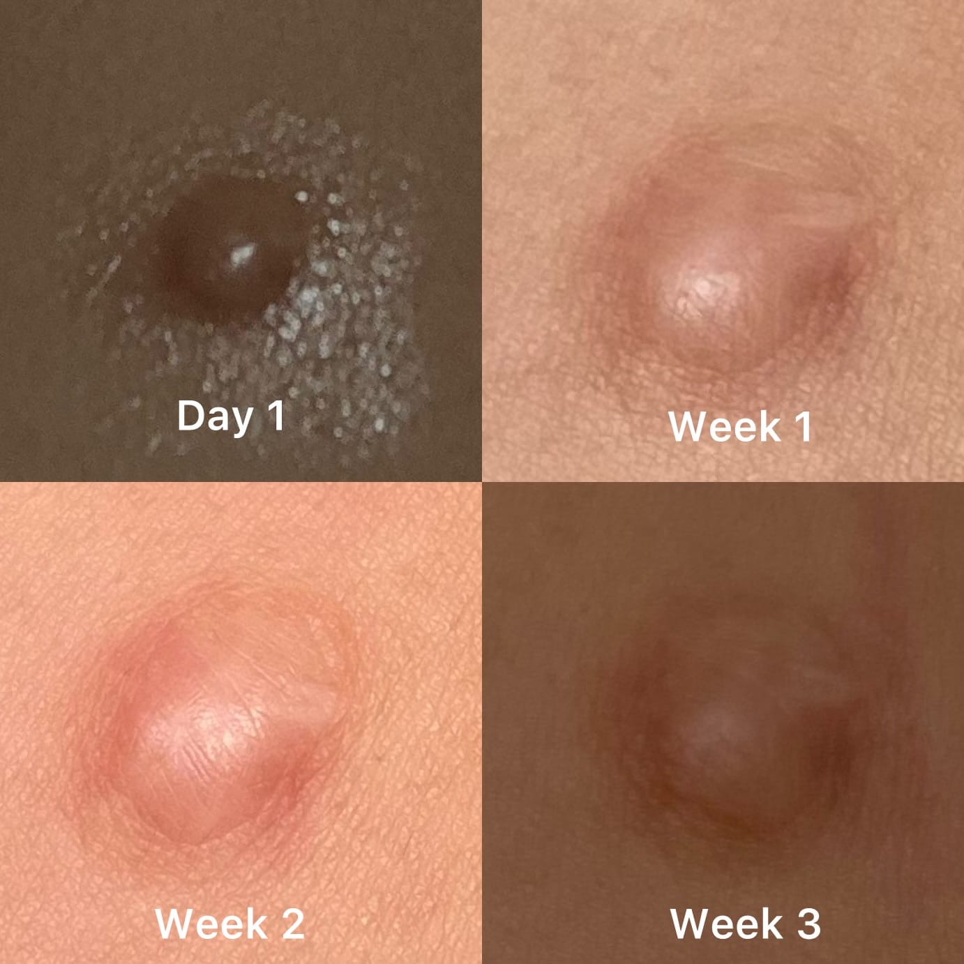 Customer photo review of Keloid Bump Shrinking Duo