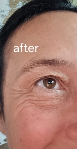 Customer photo review of EvenSkyn® Venus: Advanced Eyelid Anti-Aging Device