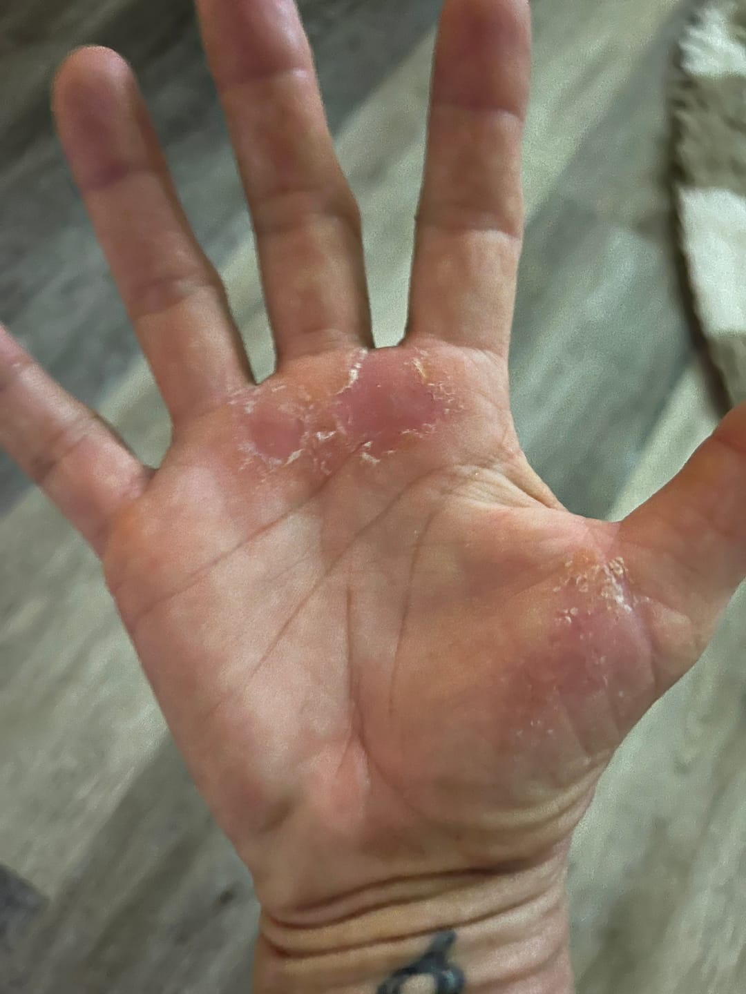 Before photo showing hand eczema flare-up before using All-In Cleanse