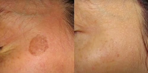 Customer photo review of Nie wieder Hautanhängsel