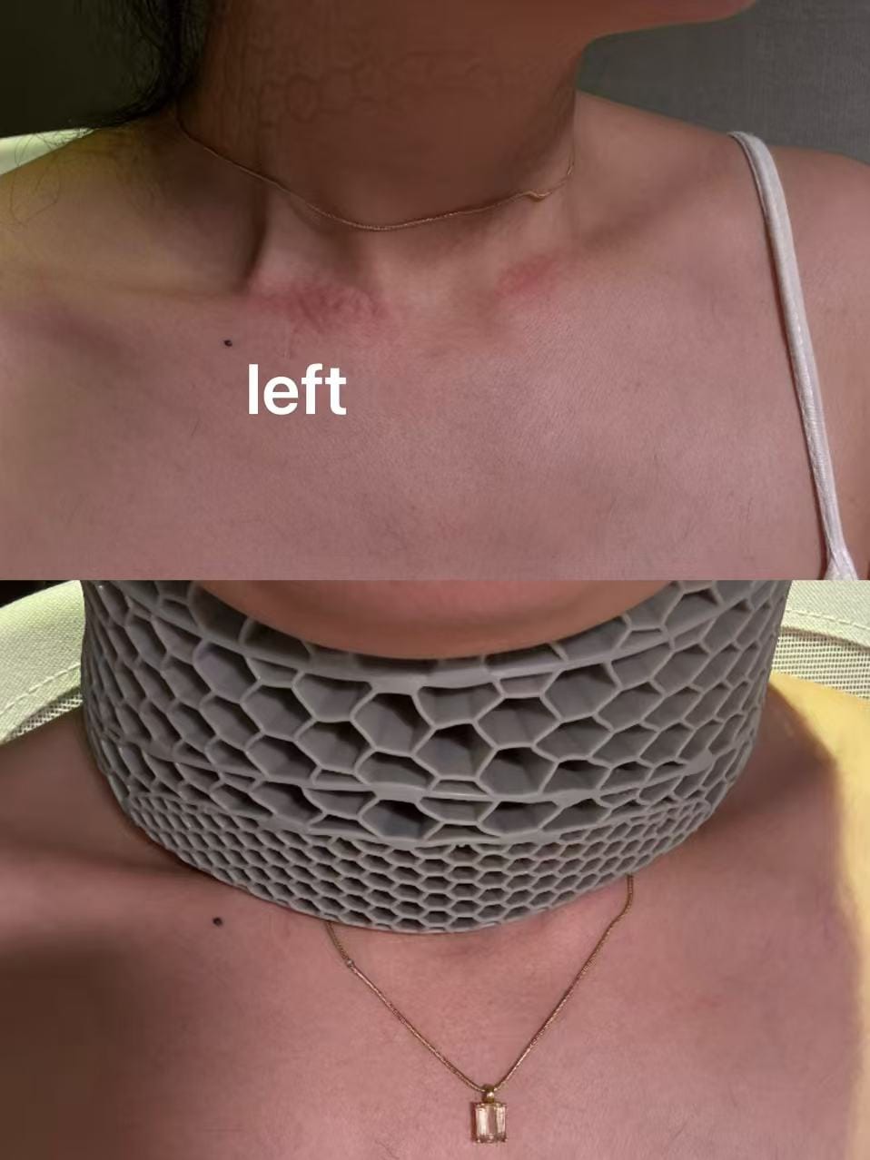 Customer photo review of CervicalEase Neck Support