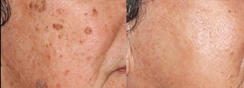 Customer photo review of Nie wieder Hautanhängsel