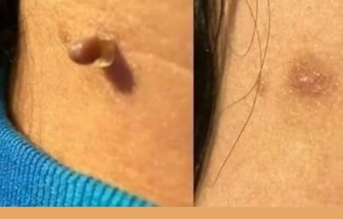 Customer photo review of Nie wieder Hautanhängsel