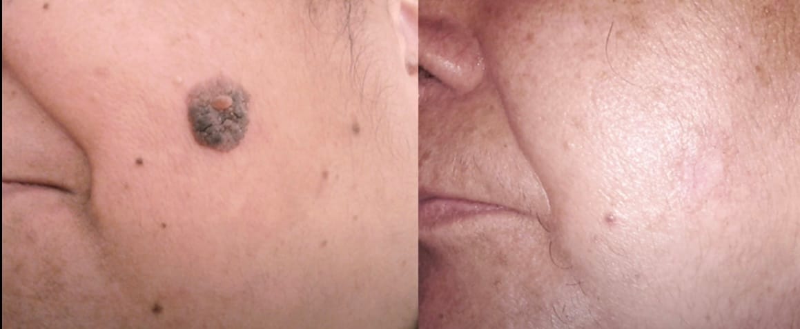 Customer photo review of Nie wieder Hautanhängsel