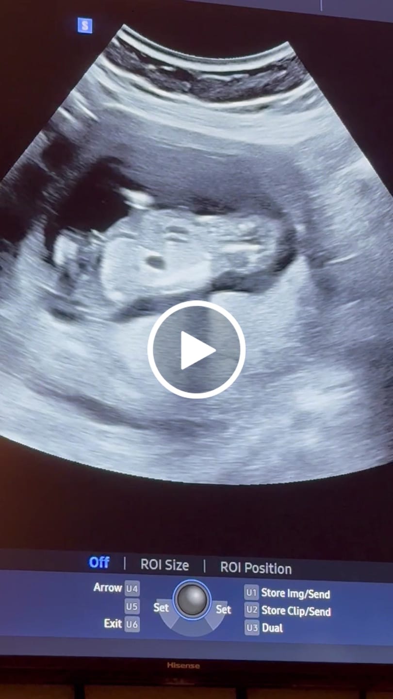 Customer video review of EarlyReveal Tap DNA Gender Test Over 99% Accurate | Painless & Needle Free