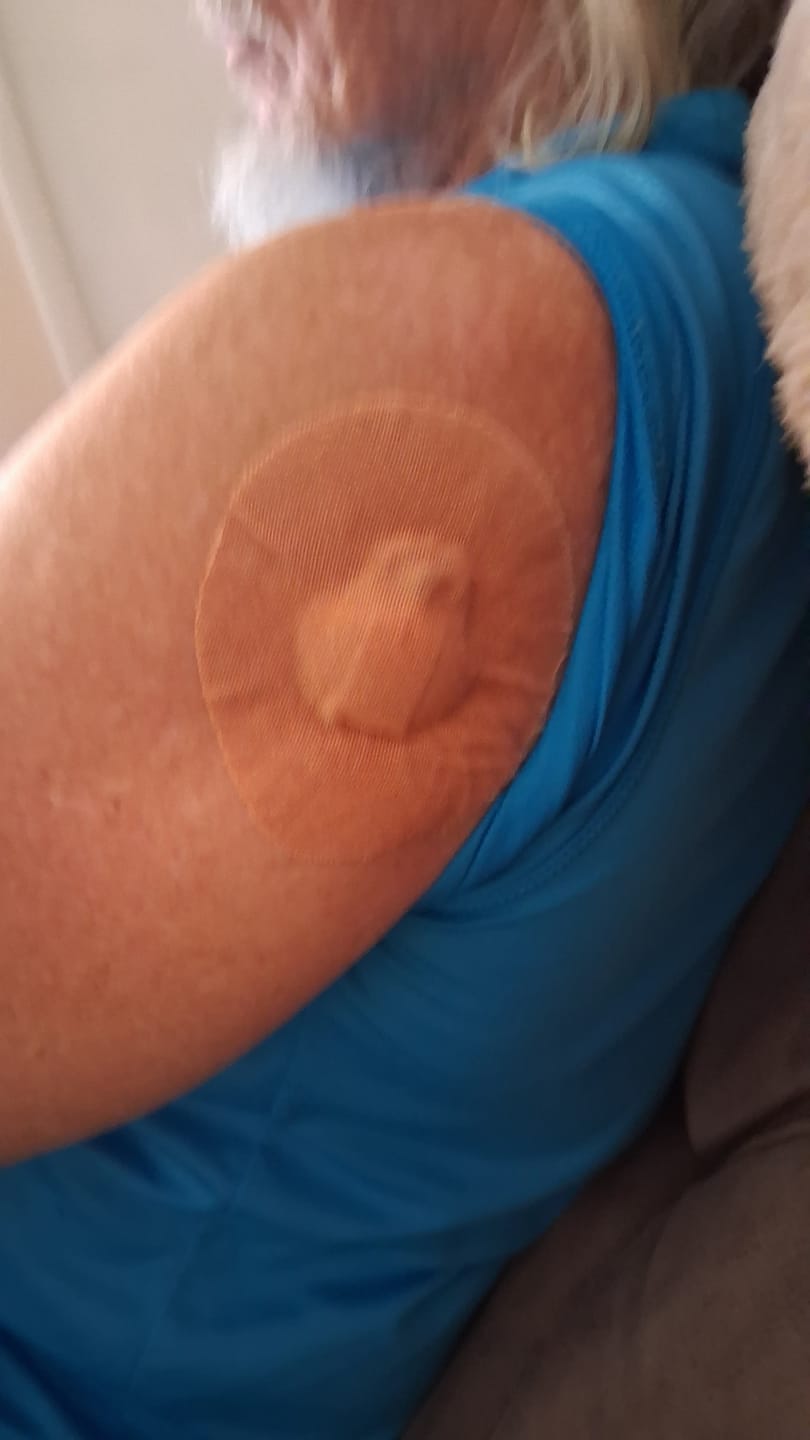Customer photo review of Skin Grip Original - Medtronic Guardian/Enlite Adhesive Patches