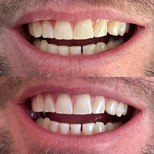 Customer photo review of Tiras Blanqueadoras Dentales VITTÉ | Tratamiento 14 días
