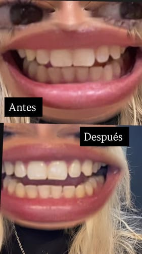 Customer photo review of Tiras Blanqueadoras Dentales VITTÉ | Tratamiento 14 días