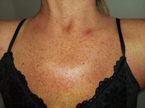 Customer photo review of Calendula Spray & Cream for Radiation Therapy Patients