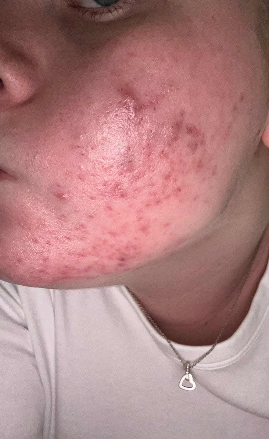 Customer photo review of THE INKEY LIST Azelaic Acid 10% Serum