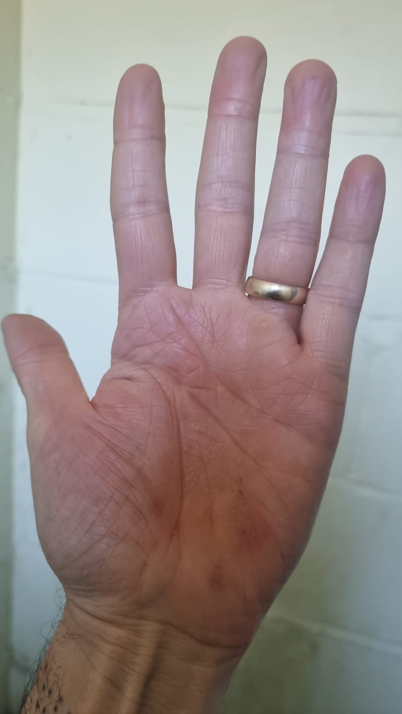Customer photo review of Bioskin Duo Pack