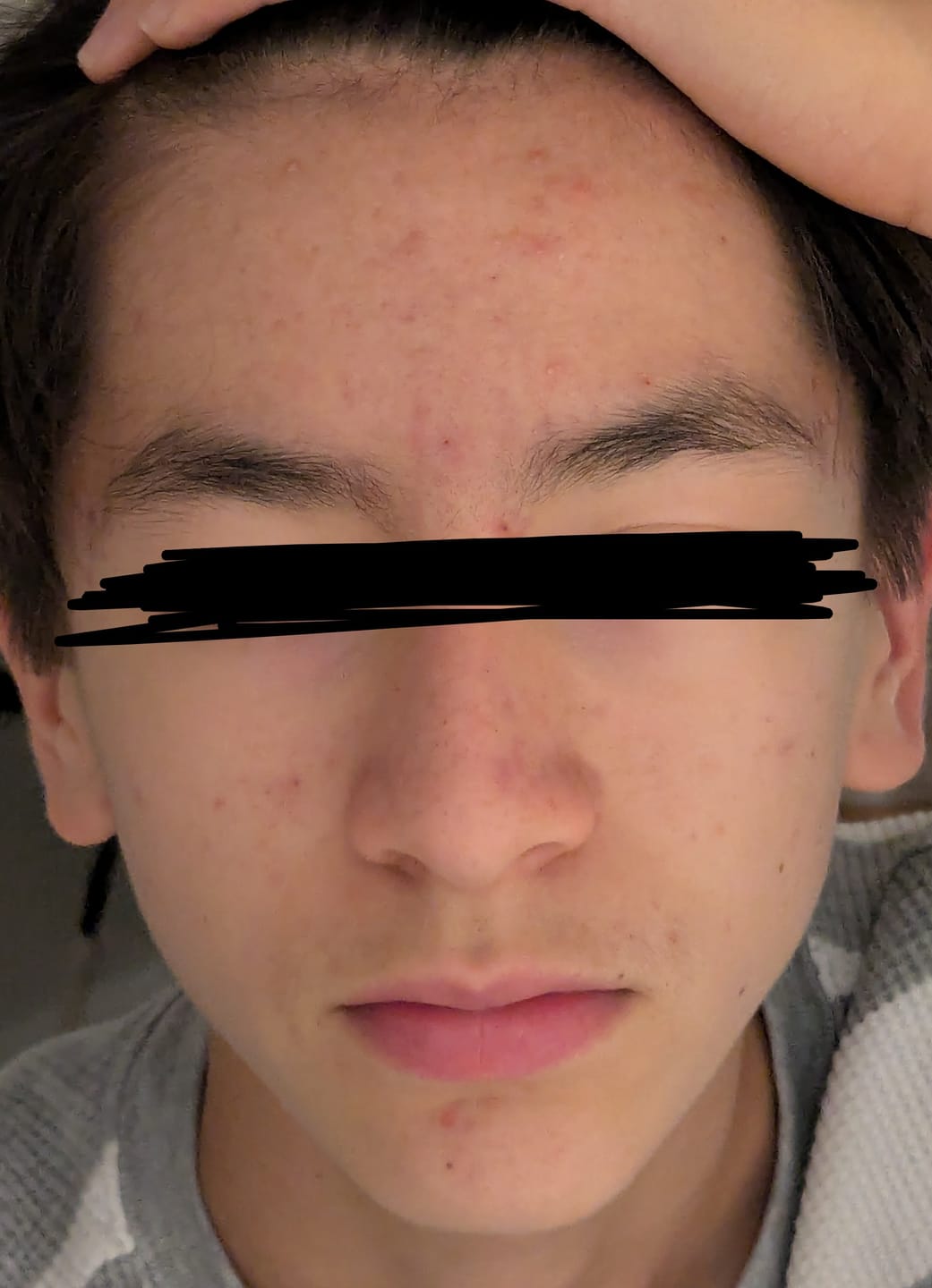 Customer photo review of Kill Acne & Redness Ritual