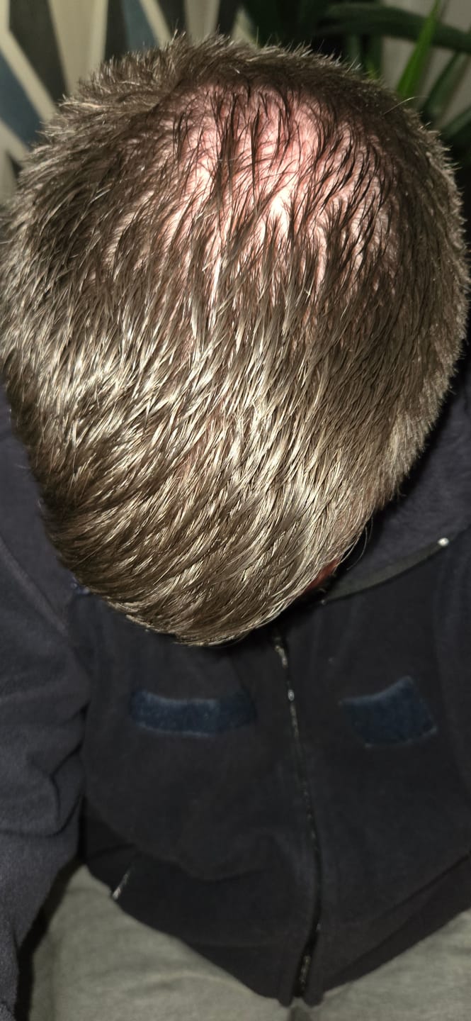 Customer photo review of SÉRUM CAPILLAIRE MULTI ACTIF BIO-DENSYL®