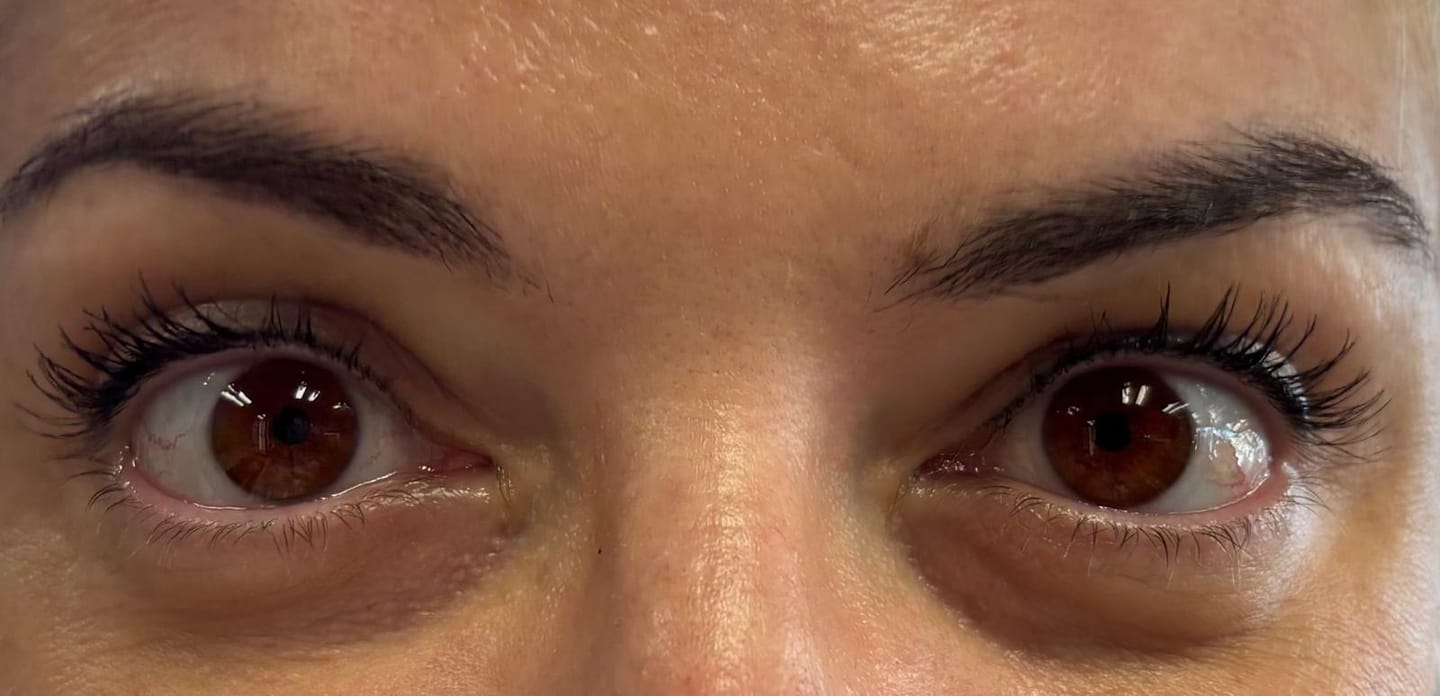 Customer photo review of Eyeling FL41 light sensitivity contact lenses