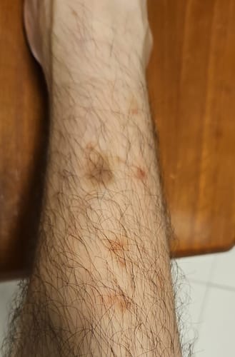 Customer photo review of Eczema Scratch Mitten