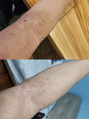 Customer photo review of Eczema Scratch Mitten